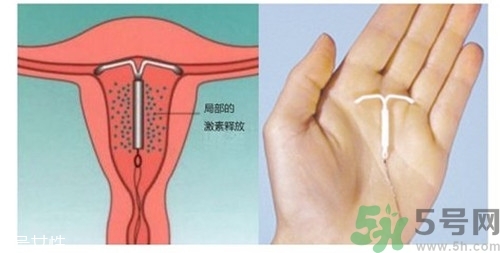 上環是什么意思？上環后注意事項有哪些？