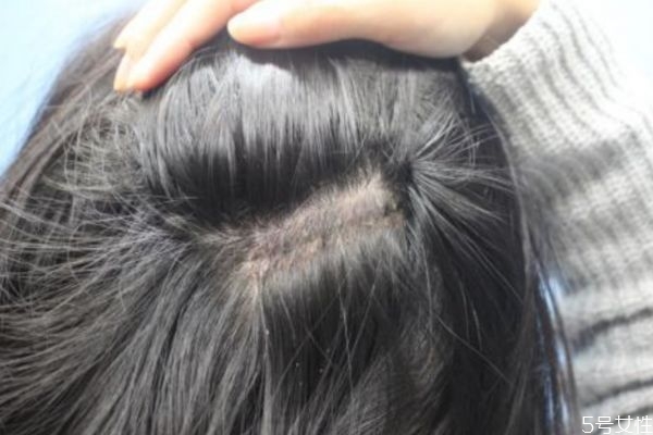 為什么會長白頭發呢 白頭發形成的原因有什么呢