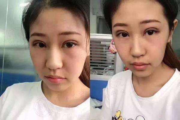 5s重瞼術有失敗的嗎 5s重瞼術的優點有哪些