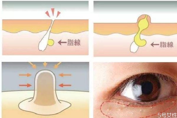 脂肪粒是怎么形成的呢 脂肪?？梢宰约汉脝?></p><h3</div>
<p class=