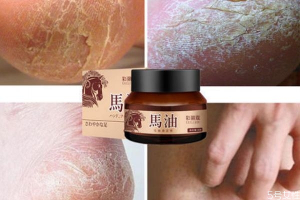 季節性手脫皮是怎么造成的呢 如何治療季節性手脫皮呢