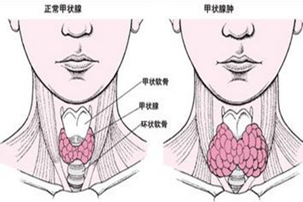甲狀腺結節會導致脖子疼嗎 甲狀腺結節有什么癥狀