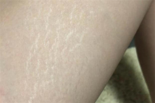 減肥后出現肥胖紋怎么辦 減肥后出現的肥胖紋會消失嗎
