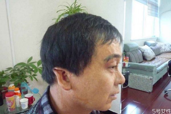 植發后會掉發嗎 植發后可能掉發嗎