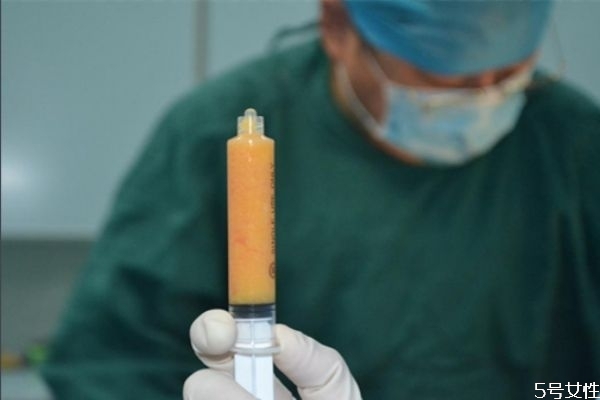 哪些部位可以做吸脂手術 哪些部位不能抽脂