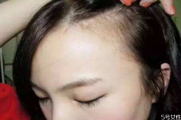 發際線后移怎么解決 發際線后移能恢復嗎