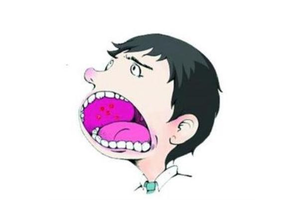 口腔潰瘍的早期癥狀 口腔潰瘍的表現癥狀