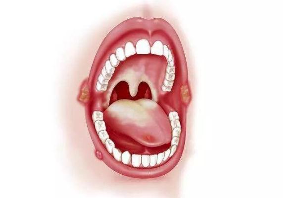 口腔潰瘍的早期癥狀 口腔潰瘍的表現癥狀