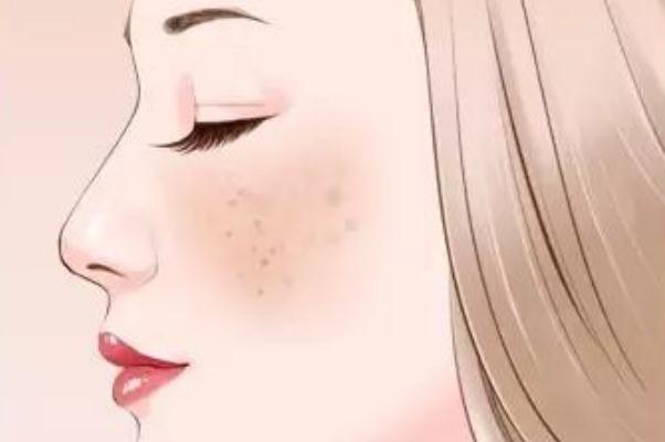 妊娠斑是怎么形成的 妊娠斑怎么調理可以淡斑