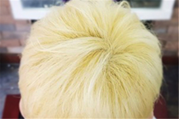 漂發后頭皮結痂用什么藥 漂發后頭皮結痂會禿嗎