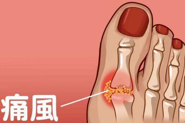 痛風吃什么藥快速消腫止痛 痛風如何簡單預(yù)防