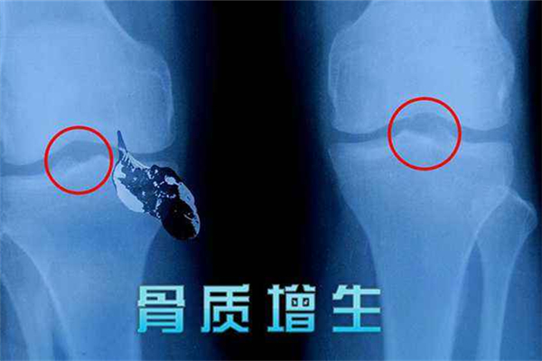 骨質增生是怎么引起的 骨質增生有哪些癥狀表現(xiàn)
