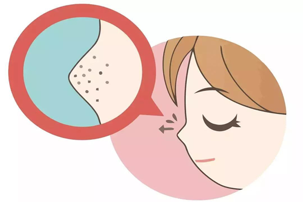 黑頭是怎么產生的 黑頭可以擠嗎