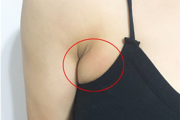 副乳是贅肉嗎 副乳跟贅肉的區別