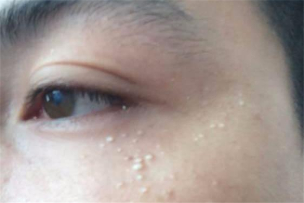脂肪粒去醫院去除需要多少錢 脂肪粒去醫院去除還是去美容院去除