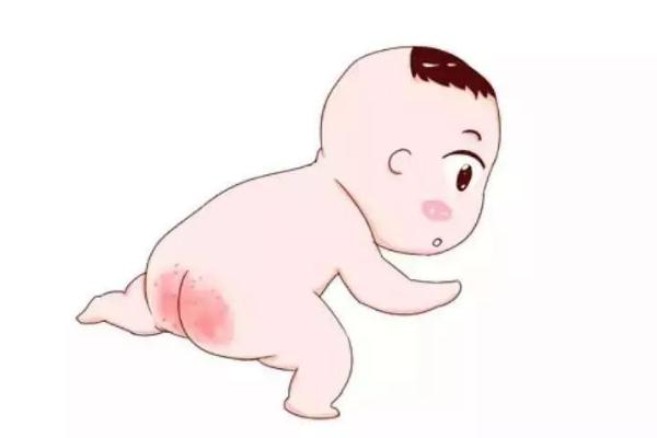 寶寶紅屁股怎么護理 寶寶紅屁股什么原因?qū)е?>
<p class=