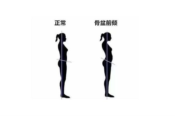 骨盆前傾的癥狀有哪些表現 骨盆前傾的原因