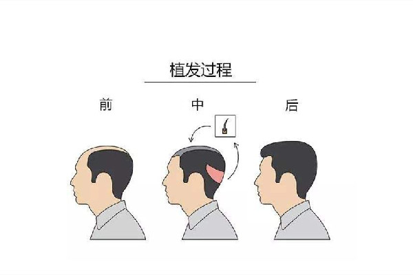 植發(fā)需要多少錢 植發(fā)按什么標(biāo)準(zhǔn)收費