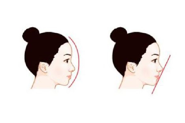 隆鼻價格大概多少 隆鼻去三甲醫院好還是美容醫院好