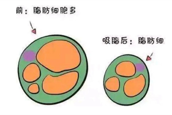 吸脂可以報醫保嗎 吸脂去三甲醫院還是美容醫院