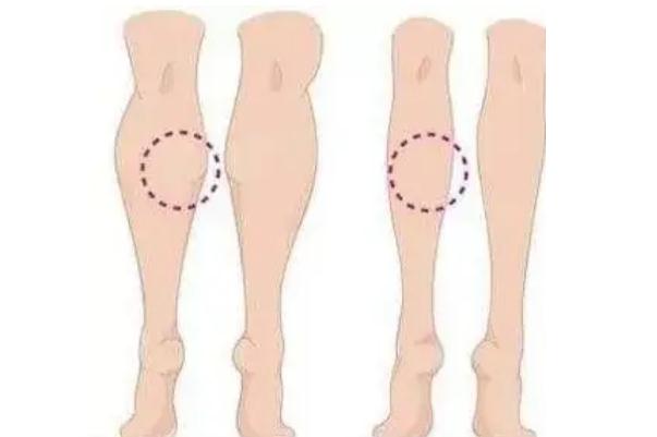 瘦腿針會影響月經嗎 瘦腿針會導致癱瘓嗎