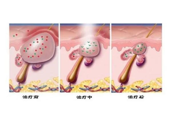 激光祛痘可以根治嗎 經期可以做激光祛痘嗎