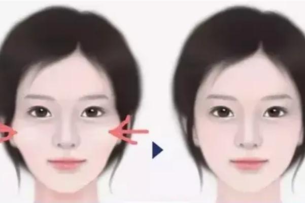 顴骨內推要開刀嗎 顴骨內推有生命危險嗎