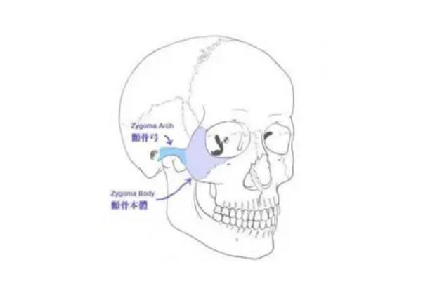 顴骨內推要開刀嗎 顴骨內推有生命危險嗎
