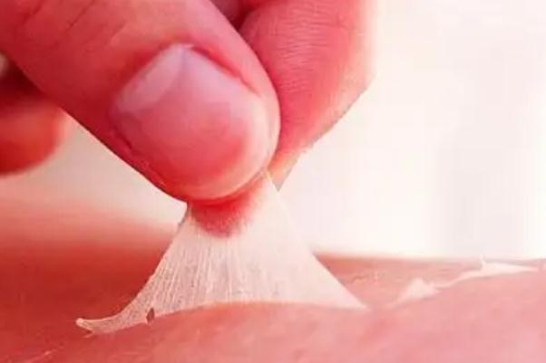 皮膚曬傷要注意什么 皮膚曬傷要去醫院嗎