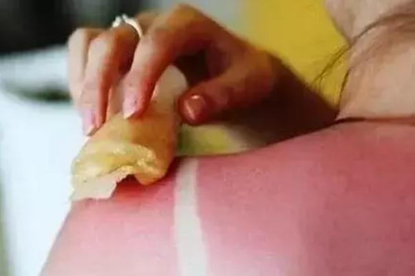 皮膚曬傷后留下黑色素該怎么去除 皮膚曬傷發紅擦什么藥