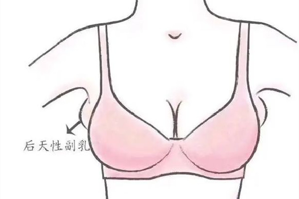 副乳切除手術(shù)是全麻還是局麻 副乳切除手術(shù)后多久可以正常活動