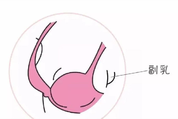 切副乳手術多少錢 切副乳手術可以報銷嗎