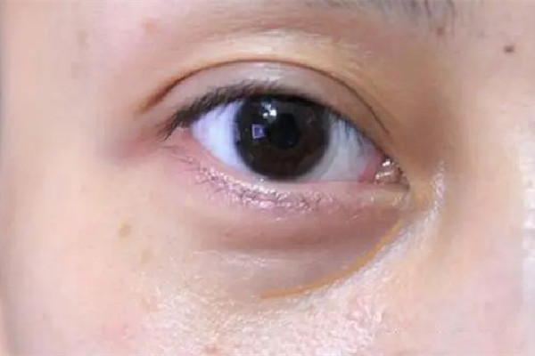武漢淚溝填充哪家比較好 武漢哪家醫院淚溝修復好