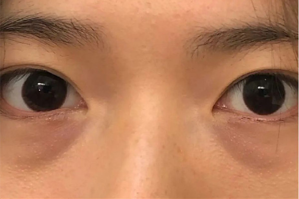 武漢哪家醫院去淚溝效果好 武漢去淚溝要花多少錢
