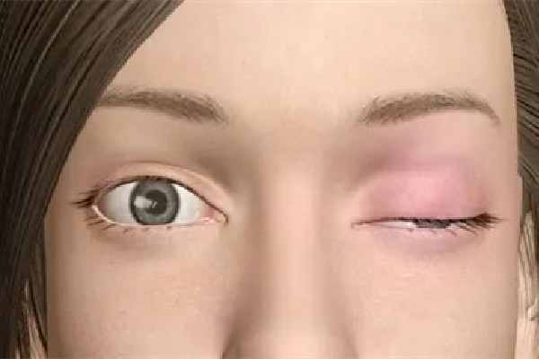 武漢上眼瞼下垂哪個醫院做的好 武漢上眼瞼下垂修復手術要多少錢