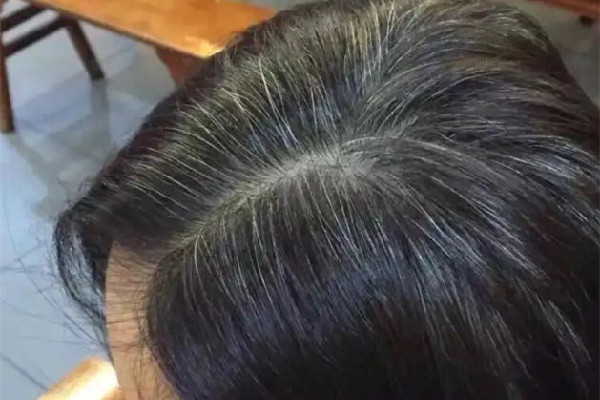 白頭發多是體內缺少什么元素 白頭發補維生素b幾