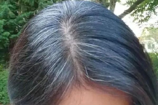 白頭發越來越多是身體哪里有問題 白頭發多和腎虛有關系嗎