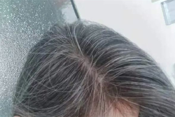 白頭發從哪開始白 白頭發為什么會越來越多