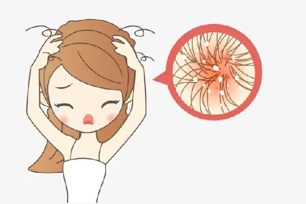 掉發會不會是洗發水的問題 掉發買什么洗發水好