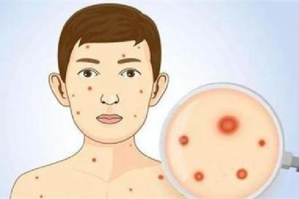 超90%的成人體內有水痘帶狀皰疹病毒 水痘帶狀皰疹會自愈嗎