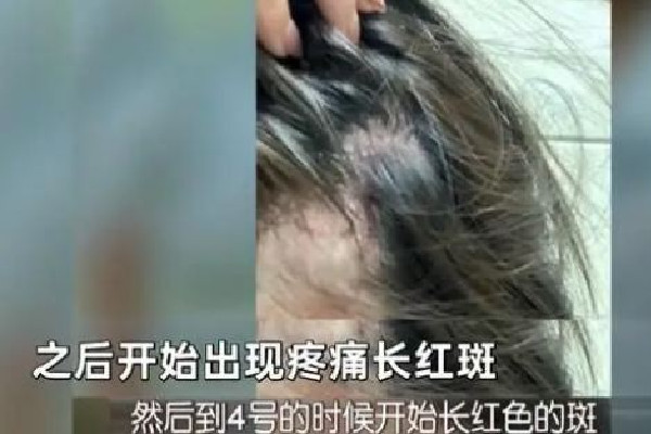 空姐注射玻尿酸打進(jìn)血管險喪命 玻尿酸注射是肌肉注射嗎